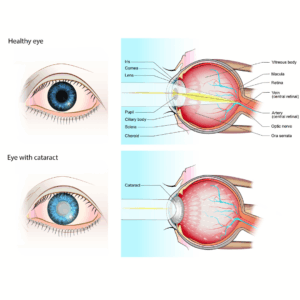 Eye Health